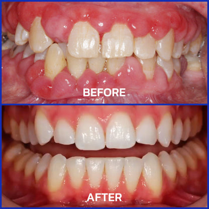 Hermsa® VioGloss Bee Venom Dental Therapy Oral Power